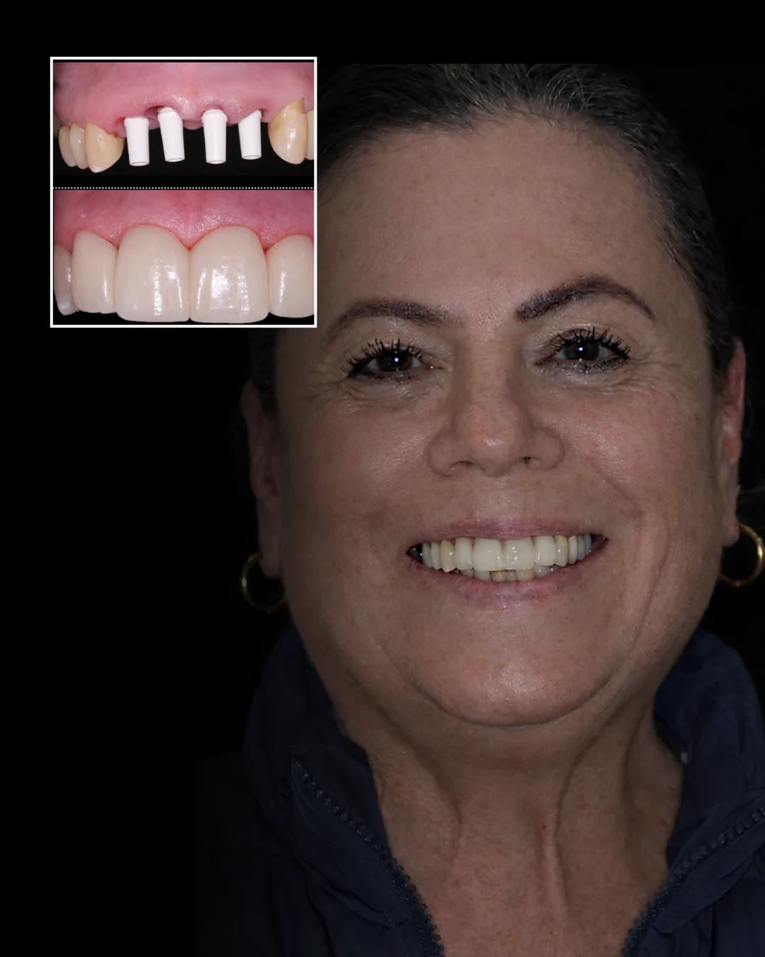 Rehabilitación anterior on-4-implants — después