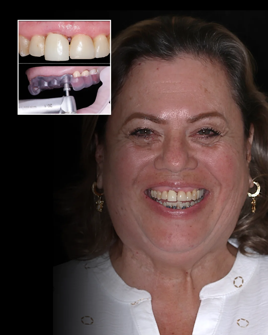 Rehabilitación anterior on-4-implants — antes