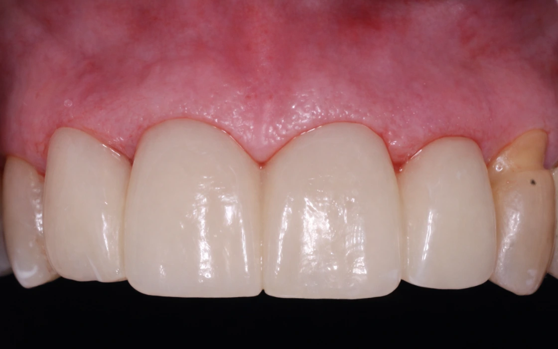 Cirugía plástica periodontal