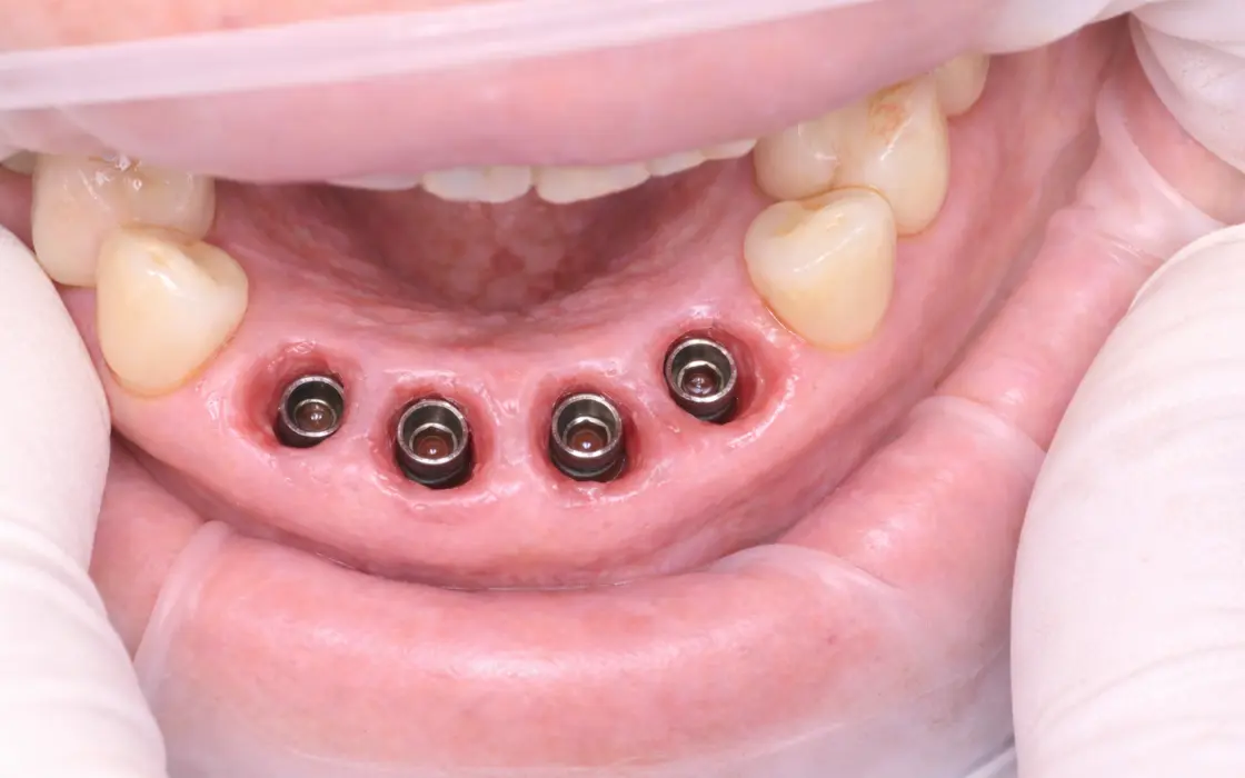 Implantología dental